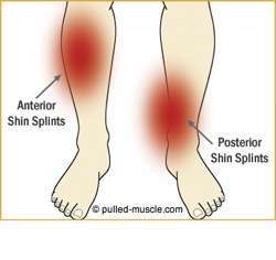 Shin Splints Treatment Shin Splints Treatment