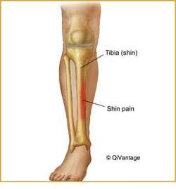 Shin Splints Shin Splints