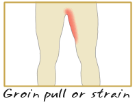 Pulled Groin | Groin Pull | Torn Groin Image